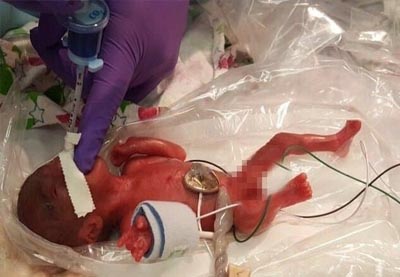 Bayi prematur dirawat di rumah sakit, lahir dengan berat badan 245g dan tinggi badan 23cm. FOTO: AFP