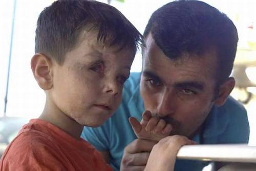 Wajah Jouma rusak akibat terkena serpihan kaca usai bus terkena serangan udara. FOTO/BBC News