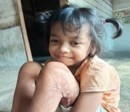 Zainil Awaliyah, bocah 9 tahun warga Desa Pekan Tebih, Kecamatan Kepenuhan Hulu, Kabupaten Rohul, butuh bantuan opersi kulit paha dan betisnya.
