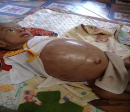 Ilmi Rahma, bayi yang berusia 6 bulan ini mengalami usus berlipat dan butuh bantuan pengobatan